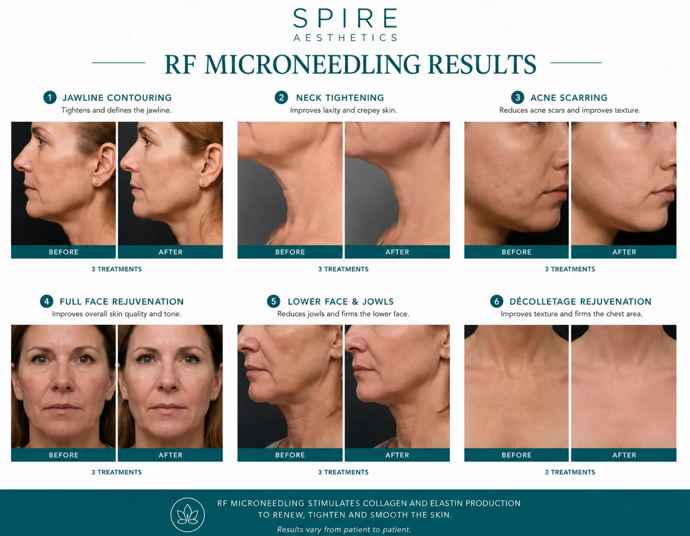 RF Microneedling Skin tightening Milton Keynes results