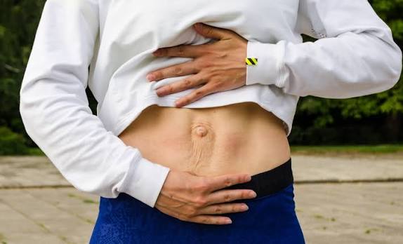 When Could Diastasis Recti Be the Missing Piece of the Puzzle Milton Keynes?