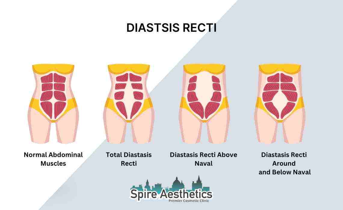 Is Non-Surgical Diastasis Recti Treatment Right for You? Common Concerns Answered Milton Keynes